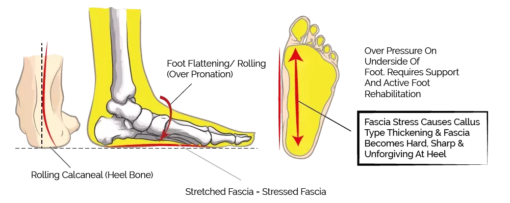 flattening arches and plantar fasciitis