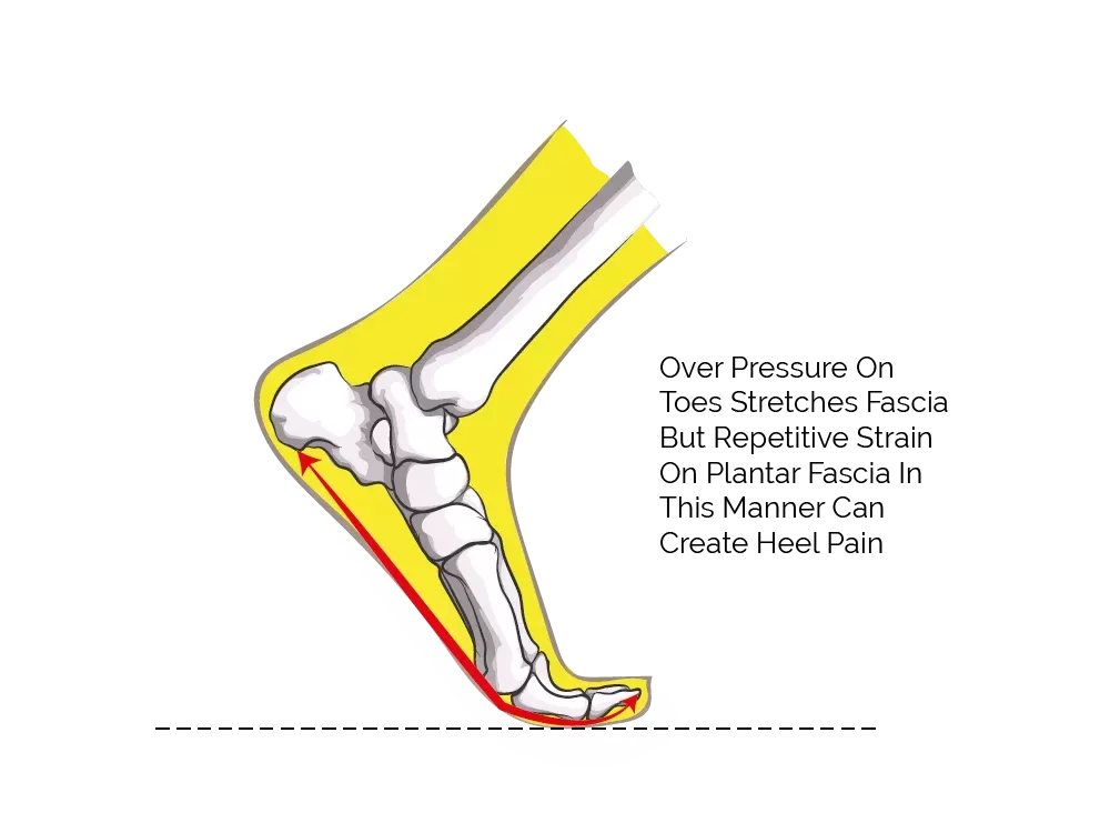 forefoot running and plantar fasciitis the causes